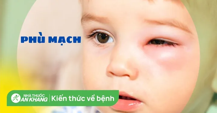 Xem Hình Ảnh Phù Mạch Và Nhận Diện Dấu Hiệu Trực Quan Cho Người Bệnh: Phân Biệt Với Mày Đay Xem Hình Ảnh Phù Mạch Và Nhận Diện Dấu Hiệu Trực Quan Cho Người Bệnh: Phân Biệt Với Mày Đay
