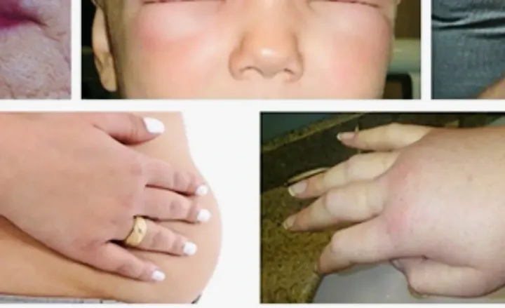 Xem Hình Ảnh Phù Mạch Và Nhận Diện Dấu Hiệu Trực Quan Cho Người Bệnh: Phân Biệt Với Mày Đay Xem Hình Ảnh Phù Mạch Và Nhận Diện Dấu Hiệu Trực Quan Cho Người Bệnh: Phân Biệt Với Mày Đay