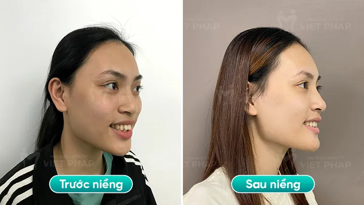 Xem Hình Ảnh Răng Vổ Và Các Loại Răng Vẩu Thường Gặp Ở Người Lớn Để Nhận Biết Đúng Tình Trạng