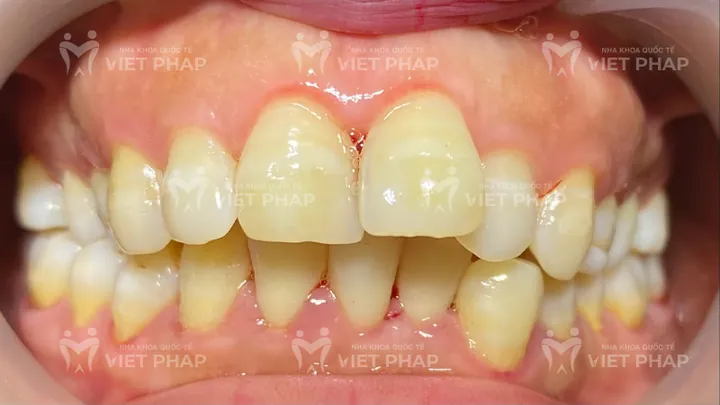 Xem Hình Ảnh Răng Vổ Và Các Loại Răng Vẩu Thường Gặp Ở Người Lớn Để Nhận Biết Đúng Tình Trạng