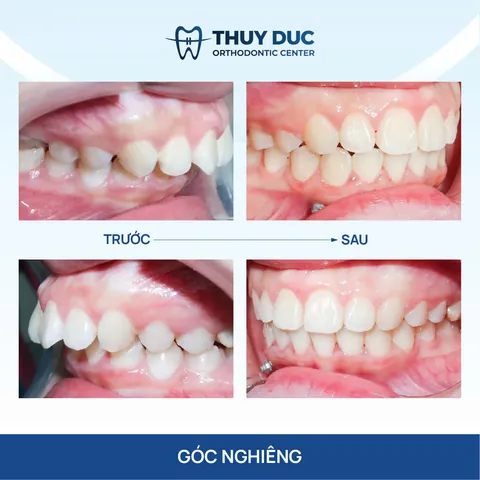 Xem Hình Ảnh Răng Vổ Và Các Loại Răng Vẩu Thường Gặp Ở Người Lớn Để Nhận Biết Đúng Tình Trạng