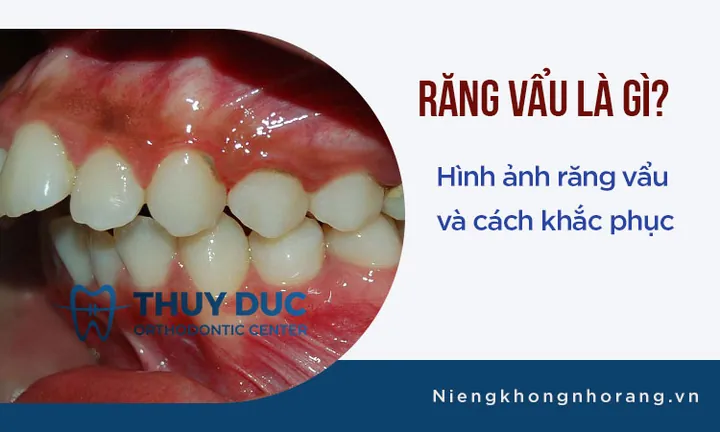Xem Hình Ảnh Răng Vổ Và Các Loại Răng Vẩu Thường Gặp Ở Người Lớn Để Nhận Biết Đúng Tình Trạng