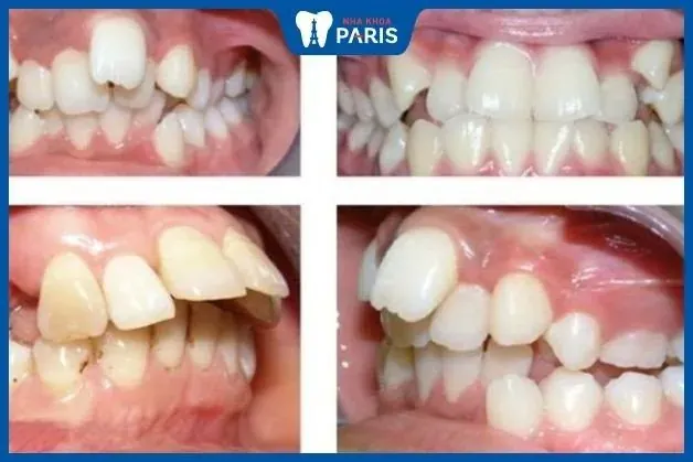 Xem Hình Ảnh Răng Vổ Và Các Loại Răng Vẩu Thường Gặp Ở Người Lớn Để Nhận Biết Đúng Tình Trạng