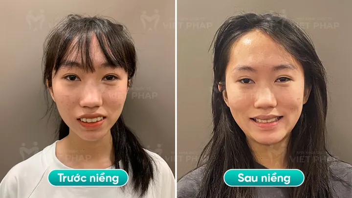 Xem Hình Ảnh Răng Vổ Và Các Loại Răng Vẩu Thường Gặp Ở Người Lớn Để Nhận Biết Đúng Tình Trạng