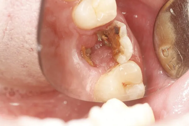 Xem Hình Ảnh Răng Vổ Và Các Loại Răng Vẩu Thường Gặp Ở Người Lớn Để Nhận Biết Đúng Tình Trạng