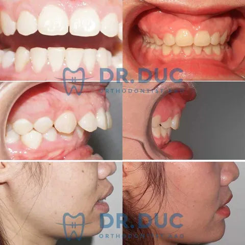 Xem Hình Ảnh Răng Vổ Và Các Loại Răng Vẩu Thường Gặp Ở Người Lớn Để Nhận Biết Đúng Tình Trạng