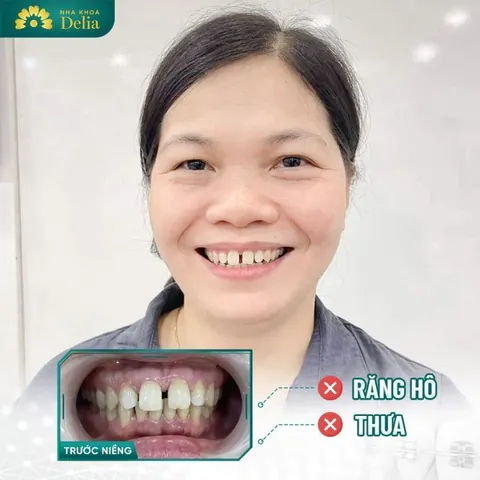 Xem Hình Ảnh Răng Vổ Và Các Loại Răng Vẩu Thường Gặp Ở Người Lớn Để Nhận Biết Đúng Tình Trạng