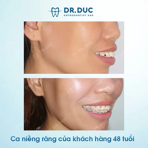Xem Hình Ảnh Răng Vổ Và Các Loại Răng Vẩu Thường Gặp Ở Người Lớn Để Nhận Biết Đúng Tình Trạng