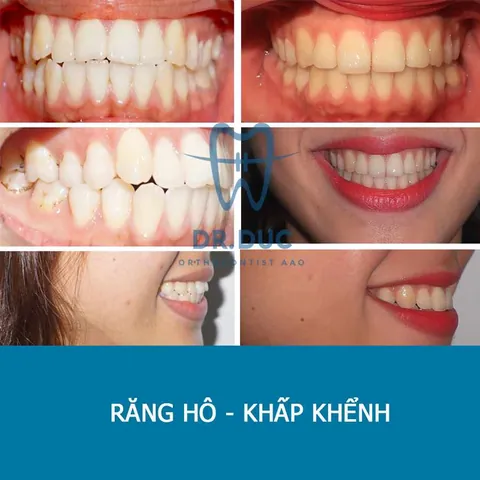 Xem Hình Ảnh Răng Vổ Và Các Loại Răng Vẩu Thường Gặp Ở Người Lớn Để Nhận Biết Đúng Tình Trạng