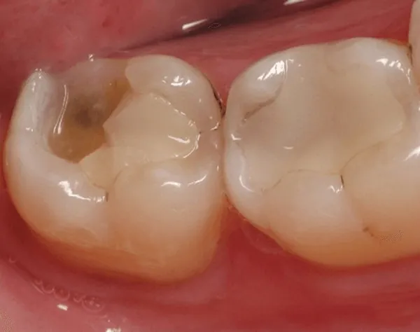 Xem Hình Ảnh Răng Vổ Và Các Loại Răng Vẩu Thường Gặp Ở Người Lớn Để Nhận Biết Đúng Tình Trạng