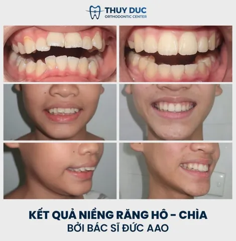 Xem Hình Ảnh Răng Vổ Và Các Loại Răng Vẩu Thường Gặp Ở Người Lớn Để Nhận Biết Đúng Tình Trạng