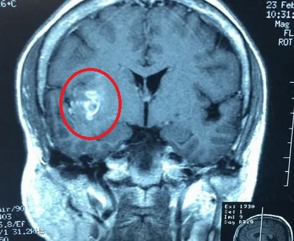 Xem Hình Ảnh Sán Não: Cách Nhận Biết Trên Ct, Mri Và Phân Biệt Với Tổn Thương Khác Cho Người Bệnh