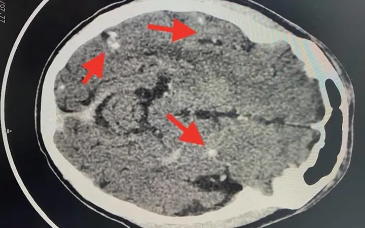 Xem Hình Ảnh Sán Não: Cách Nhận Biết Trên Ct, Mri Và Phân Biệt Với Tổn Thương Khác Cho Người Bệnh