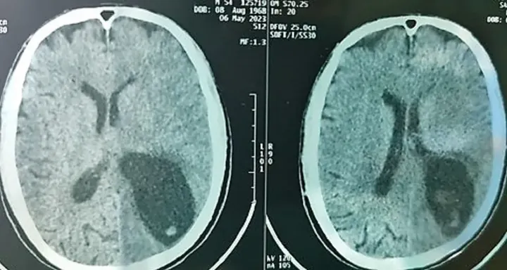 Xem Hình Ảnh Sán Não: Cách Nhận Biết Trên Ct, Mri Và Phân Biệt Với Tổn Thương Khác Cho Người Bệnh