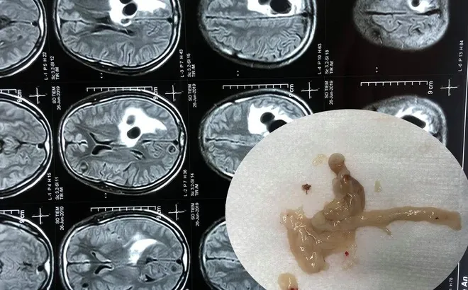 Xem Hình Ảnh Sán Não: Cách Nhận Biết Trên Ct, Mri Và Phân Biệt Với Tổn Thương Khác Cho Người Bệnh