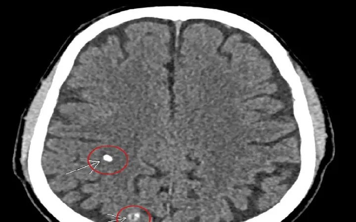 Xem Hình Ảnh Sán Não: Cách Nhận Biết Trên Ct, Mri Và Phân Biệt Với Tổn Thương Khác Cho Người Bệnh