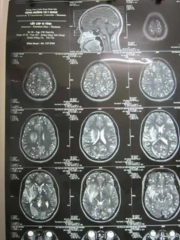 Xem Hình Ảnh Sán Não: Cách Nhận Biết Trên Ct, Mri Và Phân Biệt Với Tổn Thương Khác Cho Người Bệnh