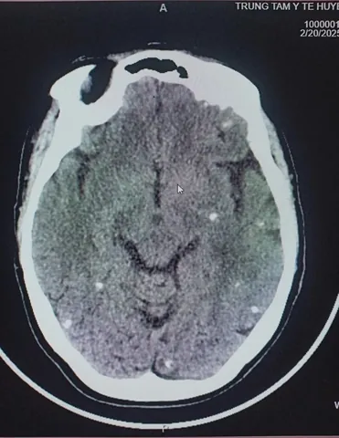 Xem Hình Ảnh Sán Não: Cách Nhận Biết Trên Ct, Mri Và Phân Biệt Với Tổn Thương Khác Cho Người Bệnh
