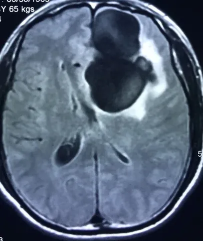 Xem Hình Ảnh Sán Não: Cách Nhận Biết Trên Ct, Mri Và Phân Biệt Với Tổn Thương Khác Cho Người Bệnh