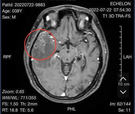 Xem Hình Ảnh Sán Não: Cách Nhận Biết Trên Ct, Mri Và Phân Biệt Với Tổn Thương Khác Cho Người Bệnh