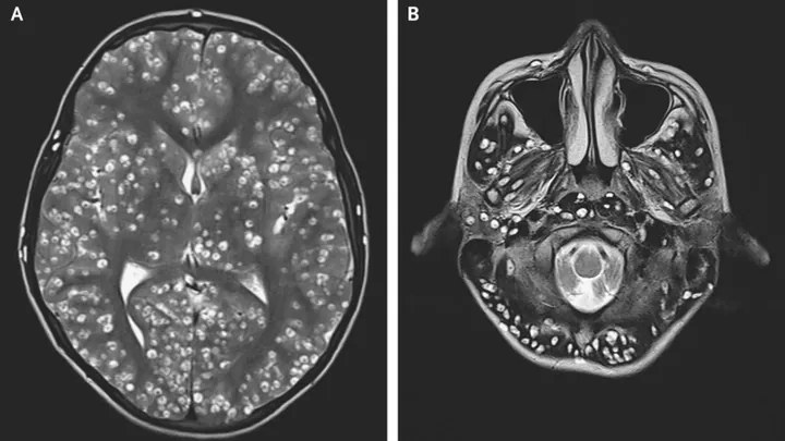Xem Hình Ảnh Sán Não: Cách Nhận Biết Trên Ct, Mri Và Phân Biệt Với Tổn Thương Khác Cho Người Bệnh