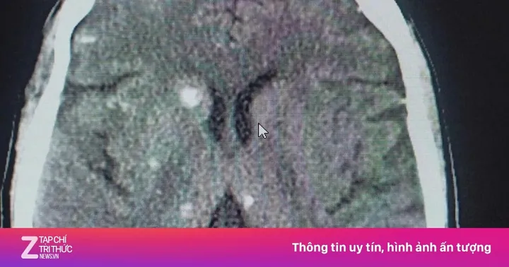 Xem Hình Ảnh Sán Não: Cách Nhận Biết Trên Ct, Mri Và Phân Biệt Với Tổn Thương Khác Cho Người Bệnh