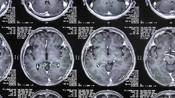 Xem Hình Ảnh Sán Não: Cách Nhận Biết Trên Ct, Mri Và Phân Biệt Với Tổn Thương Khác Cho Người Bệnh