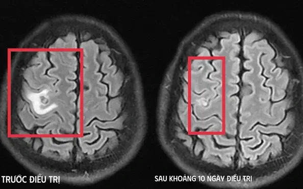 Xem Hình Ảnh Sán Não: Cách Nhận Biết Trên Ct, Mri Và Phân Biệt Với Tổn Thương Khác Cho Người Bệnh