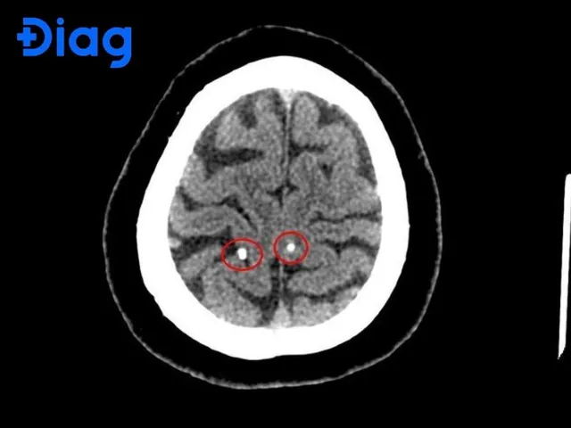 Xem Hình Ảnh Sán Não: Cách Nhận Biết Trên Ct, Mri Và Phân Biệt Với Tổn Thương Khác Cho Người Bệnh
