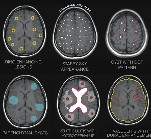 Xem Hình Ảnh Sán Não: Cách Nhận Biết Trên Ct, Mri Và Phân Biệt Với Tổn Thương Khác Cho Người Bệnh