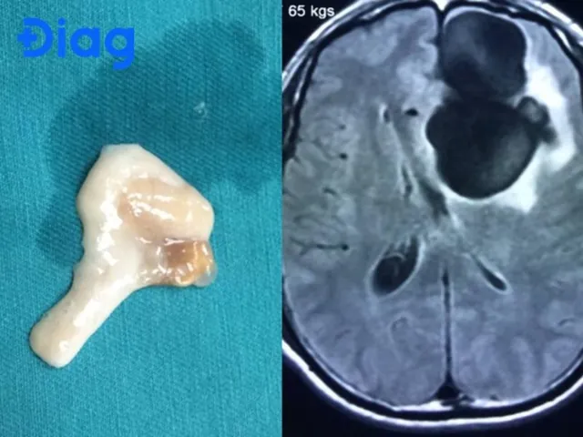 Xem Hình Ảnh Sán Não: Cách Nhận Biết Trên Ct, Mri Và Phân Biệt Với Tổn Thương Khác Cho Người Bệnh