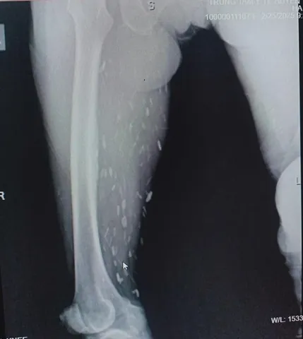 Xem Hình Ảnh Sán Não: Cách Nhận Biết Trên Ct, Mri Và Phân Biệt Với Tổn Thương Khác Cho Người Bệnh