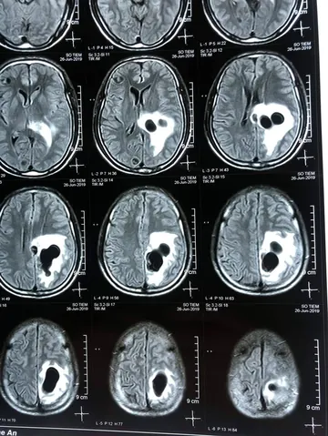 Xem Hình Ảnh Sán Não: Cách Nhận Biết Trên Ct, Mri Và Phân Biệt Với Tổn Thương Khác Cho Người Bệnh