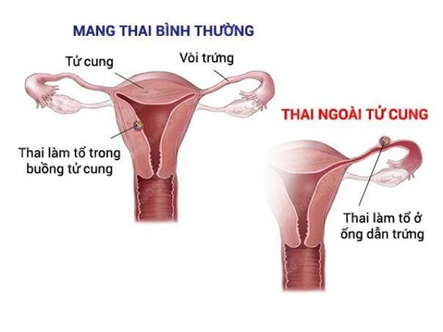 Hình Ảnh Siêu Âm Thai Mới Vào Tử Cung: Khi Nào Và Như Thế Nào Để Nhìn Thấy Phôi Thai? (dành Cho Mẹ Bầu Mới Mang Thai)