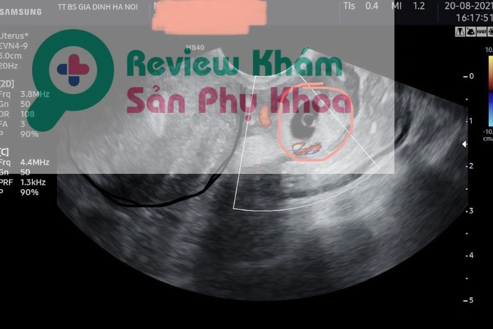 Hình Ảnh Siêu Âm Thai Mới Vào Tử Cung: Khi Nào Và Như Thế Nào Để Nhìn Thấy Phôi Thai? (dành Cho Mẹ Bầu Mới Mang Thai)