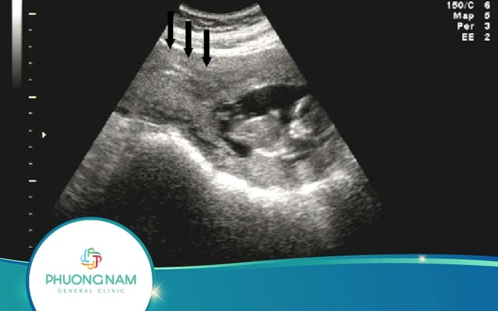 Hình Ảnh Siêu Âm Thai Mới Vào Tử Cung: Khi Nào Và Như Thế Nào Để Nhìn Thấy Phôi Thai? (dành Cho Mẹ Bầu Mới Mang Thai)