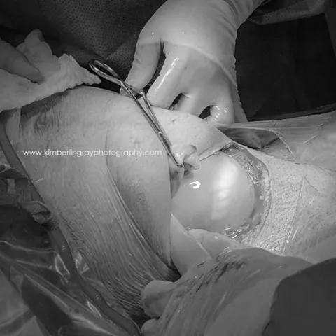 Xem Hình Ảnh Sinh Mổ Thực Tế: Quy Trình Mổ Lấy Thai & Vết Sẹo Cho Mẹ Bầu Xem Hình Ảnh Sinh Mổ Thực Tế: Quy Trình Mổ Lấy Thai & Vết Sẹo Cho Mẹ Bầu