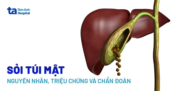 Xem Hình Ảnh Sỏi Mật Thực Tế: Phân Loại Sỏi Túi Mật Và Sỏi Ống Mật Chủ Cho Người Bệnh Xem Hình Ảnh Sỏi Mật Thực Tế: Phân Loại Sỏi Túi Mật Và Sỏi Ống Mật Chủ Cho Người Bệnh