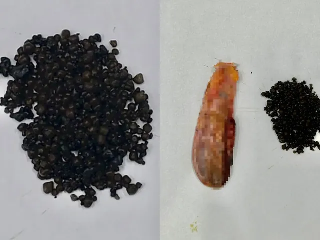 Xem Hình Ảnh Sỏi Mật Thực Tế: Phân Loại Sỏi Túi Mật Và Sỏi Ống Mật Chủ Cho Người Bệnh Xem Hình Ảnh Sỏi Mật Thực Tế: Phân Loại Sỏi Túi Mật Và Sỏi Ống Mật Chủ Cho Người Bệnh