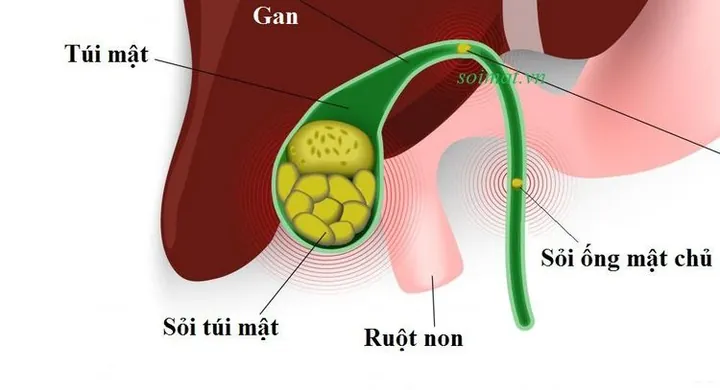 Xem Hình Ảnh Sỏi Mật Thực Tế: Phân Loại Sỏi Túi Mật Và Sỏi Ống Mật Chủ Cho Người Bệnh Xem Hình Ảnh Sỏi Mật Thực Tế: Phân Loại Sỏi Túi Mật Và Sỏi Ống Mật Chủ Cho Người Bệnh