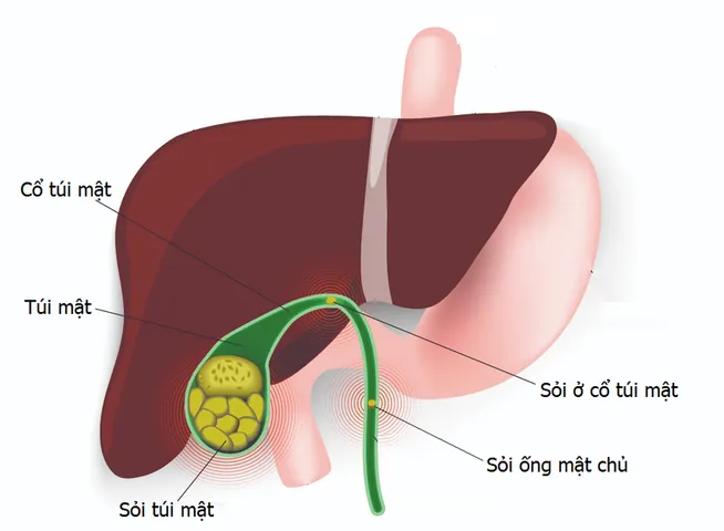 Xem Hình Ảnh Sỏi Mật Thực Tế: Phân Loại Sỏi Túi Mật Và Sỏi Ống Mật Chủ Cho Người Bệnh Xem Hình Ảnh Sỏi Mật Thực Tế: Phân Loại Sỏi Túi Mật Và Sỏi Ống Mật Chủ Cho Người Bệnh