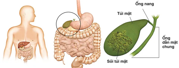Xem Hình Ảnh Sỏi Mật Thực Tế: Phân Loại Sỏi Túi Mật Và Sỏi Ống Mật Chủ Cho Người Bệnh Xem Hình Ảnh Sỏi Mật Thực Tế: Phân Loại Sỏi Túi Mật Và Sỏi Ống Mật Chủ Cho Người Bệnh