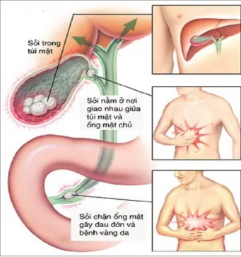 Xem Hình Ảnh Sỏi Mật Thực Tế: Phân Loại Sỏi Túi Mật Và Sỏi Ống Mật Chủ Cho Người Bệnh Xem Hình Ảnh Sỏi Mật Thực Tế: Phân Loại Sỏi Túi Mật Và Sỏi Ống Mật Chủ Cho Người Bệnh