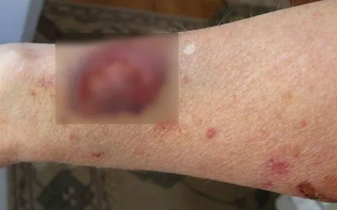 Xem Hình Ảnh Teo Da: Nguyên Nhân, Triệu Chứng Và Cách Điều Trị Cho Người Nghi Ngờ Da Mỏng Do Corticoid Xem Hình Ảnh Teo Da: Nguyên Nhân, Triệu Chứng Và Cách Điều Trị Cho Người Nghi Ngờ Da Mỏng Do Corticoid