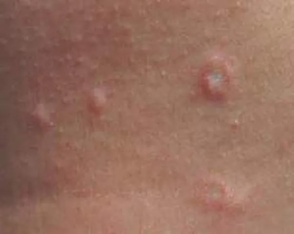 Xem Hình Ảnh Teo Da: Nguyên Nhân, Triệu Chứng Và Cách Điều Trị Cho Người Nghi Ngờ Da Mỏng Do Corticoid Xem Hình Ảnh Teo Da: Nguyên Nhân, Triệu Chứng Và Cách Điều Trị Cho Người Nghi Ngờ Da Mỏng Do Corticoid