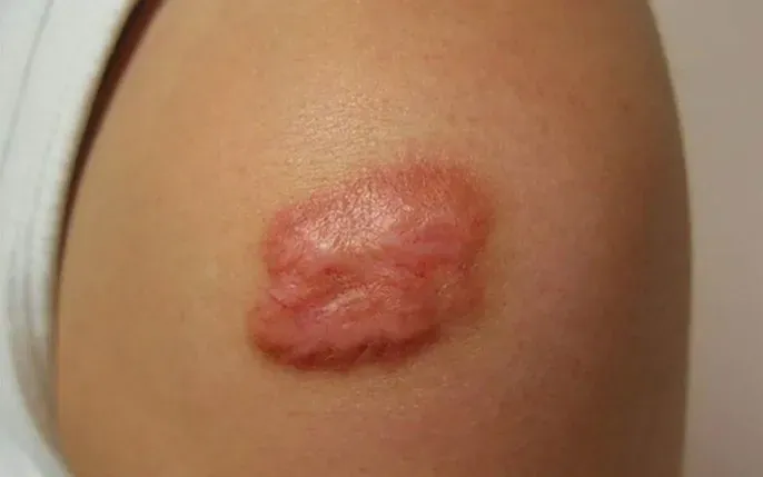 Xem Hình Ảnh Teo Da: Nguyên Nhân, Triệu Chứng Và Cách Điều Trị Cho Người Nghi Ngờ Da Mỏng Do Corticoid Xem Hình Ảnh Teo Da: Nguyên Nhân, Triệu Chứng Và Cách Điều Trị Cho Người Nghi Ngờ Da Mỏng Do Corticoid