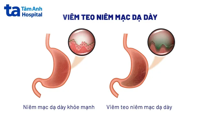 Xem Hình Ảnh Teo Da: Nguyên Nhân, Triệu Chứng Và Cách Điều Trị Cho Người Nghi Ngờ Da Mỏng Do Corticoid Xem Hình Ảnh Teo Da: Nguyên Nhân, Triệu Chứng Và Cách Điều Trị Cho Người Nghi Ngờ Da Mỏng Do Corticoid