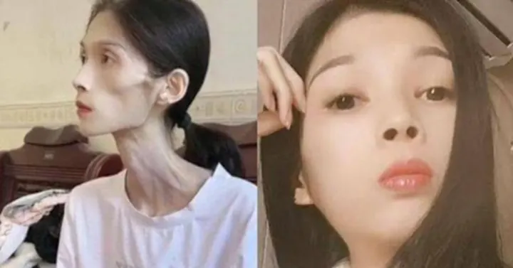 Xem Hình Ảnh Teo Da: Nguyên Nhân, Triệu Chứng Và Cách Điều Trị Cho Người Nghi Ngờ Da Mỏng Do Corticoid Xem Hình Ảnh Teo Da: Nguyên Nhân, Triệu Chứng Và Cách Điều Trị Cho Người Nghi Ngờ Da Mỏng Do Corticoid