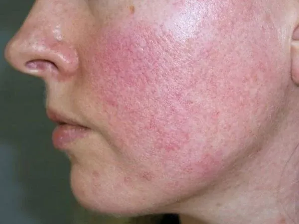 Xem Hình Ảnh Teo Da: Nguyên Nhân, Triệu Chứng Và Cách Điều Trị Cho Người Nghi Ngờ Da Mỏng Do Corticoid Xem Hình Ảnh Teo Da: Nguyên Nhân, Triệu Chứng Và Cách Điều Trị Cho Người Nghi Ngờ Da Mỏng Do Corticoid