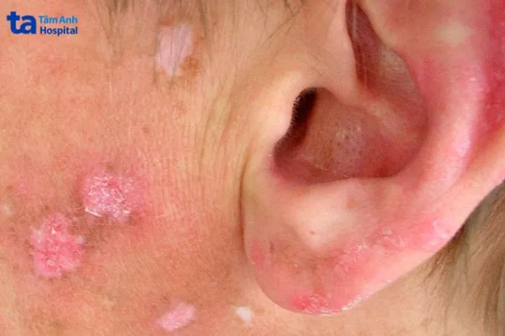 Xem Hình Ảnh Teo Da: Nguyên Nhân, Triệu Chứng Và Cách Điều Trị Cho Người Nghi Ngờ Da Mỏng Do Corticoid Xem Hình Ảnh Teo Da: Nguyên Nhân, Triệu Chứng Và Cách Điều Trị Cho Người Nghi Ngờ Da Mỏng Do Corticoid